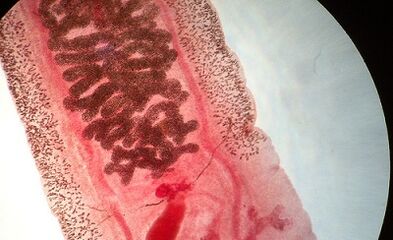 Anquilostomosis emberekben